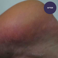 Footlogix DD Cream Mousse Formula (125ml)